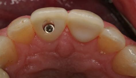 Implant Crowns Specialist Oral Health Care And Advice Prosthodontics