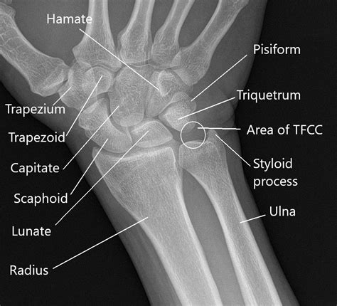 Wrist Pain Causes And Management Complete Orthopedics Multiple Ny