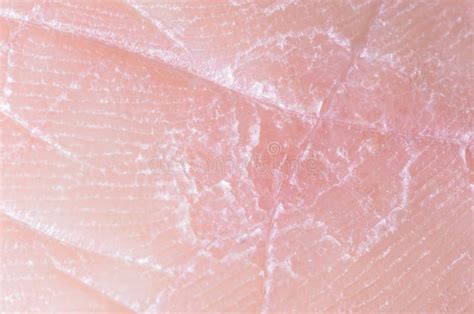 Dry Skin Stock Image Image Of Hospital Lesion Eczema 34808355