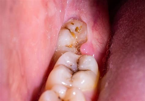 Why Are Wisdom Teeth Removed Reasons And Extraction Procedure