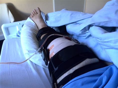 The Slow Recovery From A Complete Quadriceps Tendon Rupture An