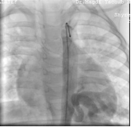 Figure 1 From A Rare Cause Of Machinery Murmur Aorta To Left Lower