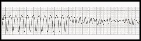 In this ecg video we review the characteristics of ventricular fibrillation or vfib. Float Nurse: EKG Rhythm Quiz 288