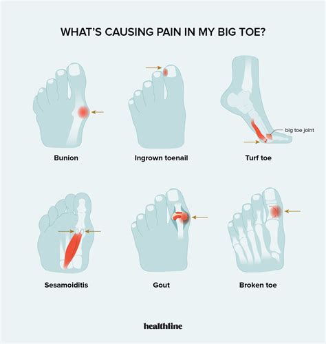 Painful Big Toe Artofit