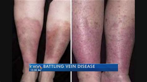New Vein Disease Treatment Arrives In Austin Youtube