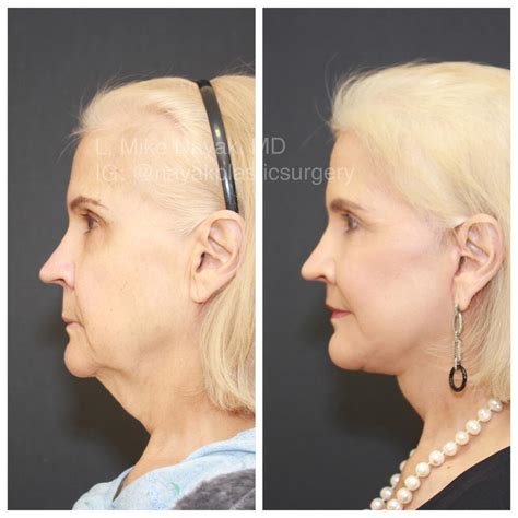 Facelift And Neck Before And After Patient 06 Nayak Plastic Surgery