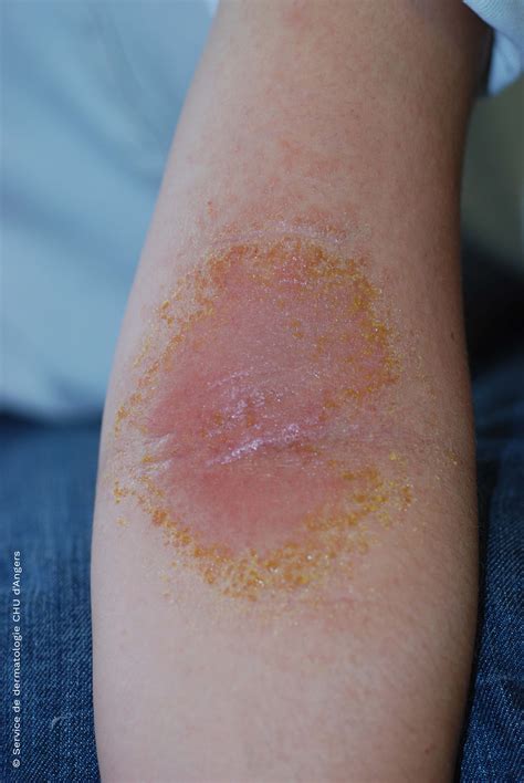 Eczema On Elbows