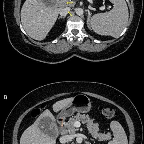 Axial Intravenous Contrast Enhanced Ct Images Of The Abdomen And