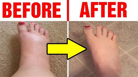 Best Home Remedies For Swollen Feethow To Reduce Swollen Feet Youtube