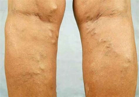 Bulging Veins Pictures Causes Prevention And Treatment
