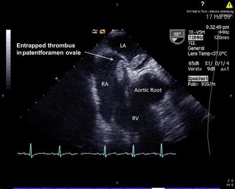 Figure 2 From Patent Foramen Ovale And Major Pulmonary Embolism