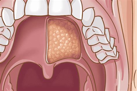 Learn About Oral Salivary Gland Cancer ‣ Thanc Guide