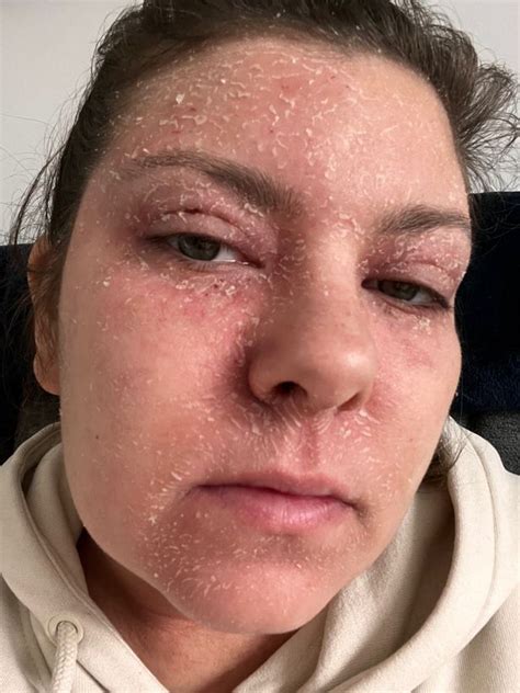 Mum Who Dreaded Leaving Home After Allergic Reaction Made Face Bright Red Says High Street