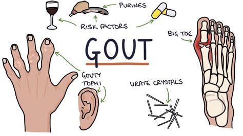 Gout Visual Explanation For Students Youtube