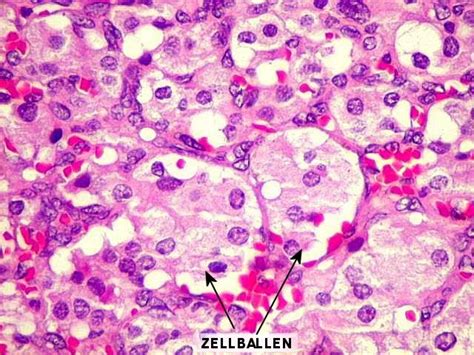 zellballen pattern: paraganglioma (carotid body tumor) | Pattern, Red