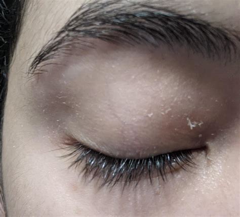 Skin Concerns Peelingflaking Eyelids Any Eye Safe Gentle Solutions