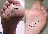 Foot Corn Treatment Doctor Pictures