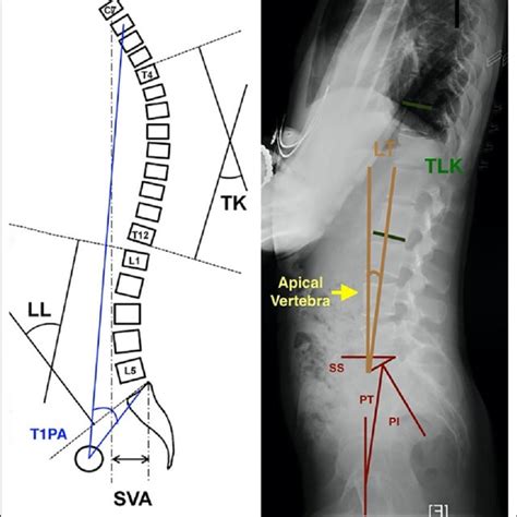 The Overall Sagittal Parameters Under Roussouly Classification