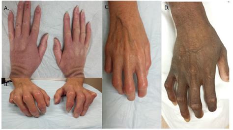 Phases Of Skin Involvement In Ssc A Initial Edematous Phase Of Ssc