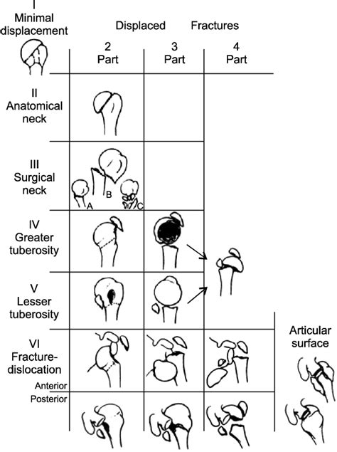 The Neer System For Classification Of Fractures Of The Proximal Humerus