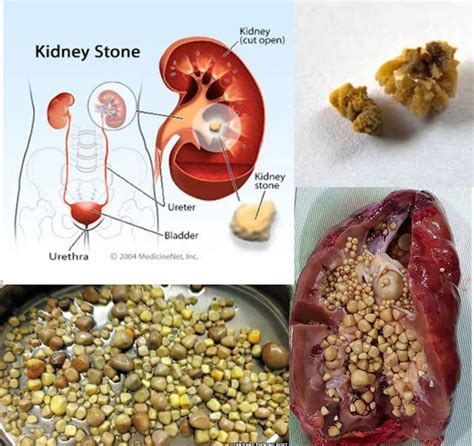 The Causes Of Kidney Stones