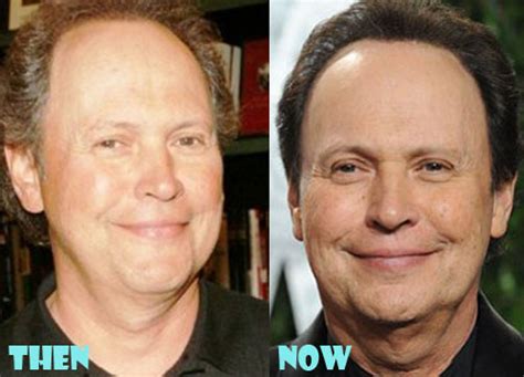 Billy Crystal Plastic Surgery Before After Pictures Lovely Surgery