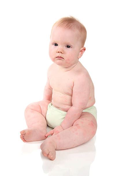 Diaper Rash Stock Photos Pictures And Royalty Free Images Istock