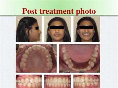 Extraction Teeth For Gaining Space In Orthodontics