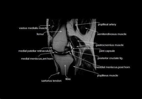 Knee Muscle Anatomy Mri Knee Muscle Anatomy Mri Use The Mouse To