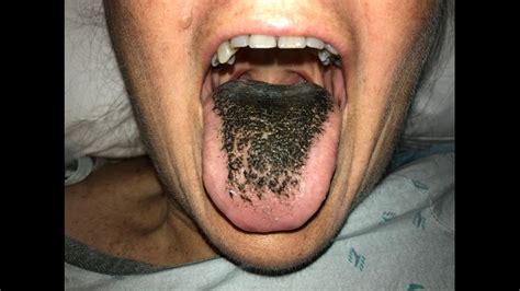Woman Treated With Antibiotics Develops Black Hairy Tongue