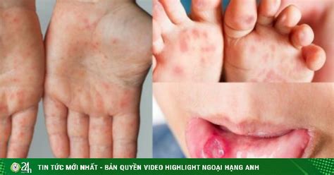 Dịch tay chân miệng bùng phát xuất hiện chủng virus dễ gây bệnh nặng