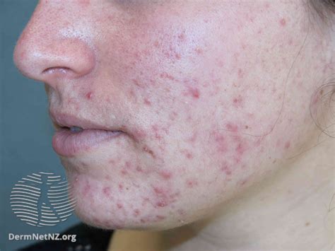 Acne Treatment Types And More