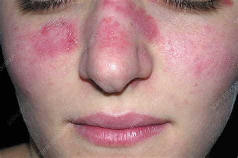 Lupus (systemic lupus erythematosus) causes symptoms like joint pain, tiredness and skin rashes. Discoid lupus - Stock Image - C023/4539 - Science Photo ...