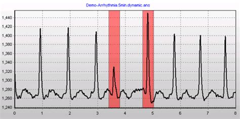 Premature or extra beats are the most common arrhythmia types. Event Monitor For Arrhythmia - christening outfits baby boy