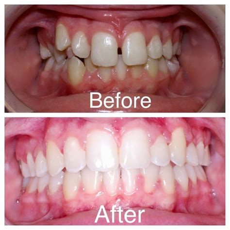 Pin On Before And After Orthodontic Pictures