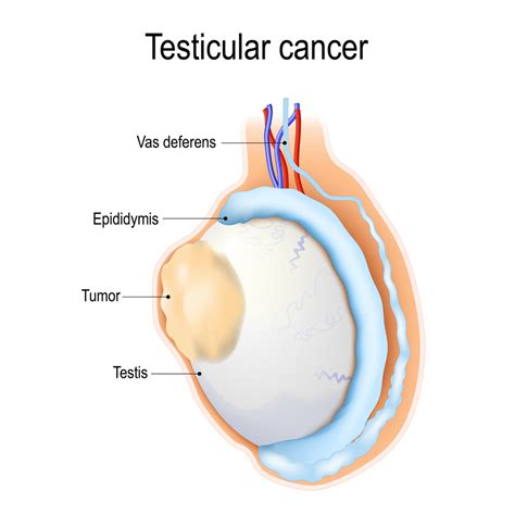 Testicular Cancer Symptoms Stages Diagnosis Risk Factors And Treatment