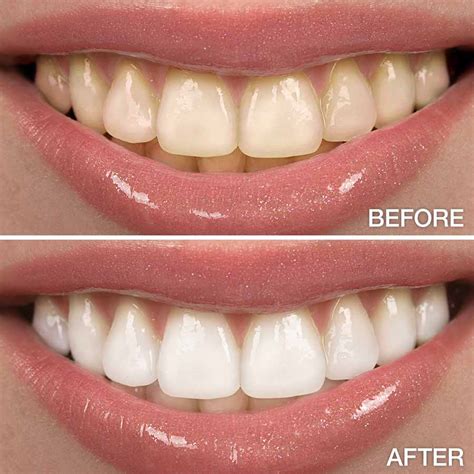Teeth Whitening Kelvin B Smith D D S LLC Baltimore