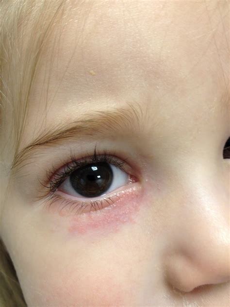 Periocular Dermatitis Around Eyes