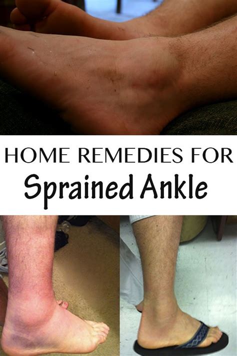 Home Remedies For Sprained Ankle Everything In One Place