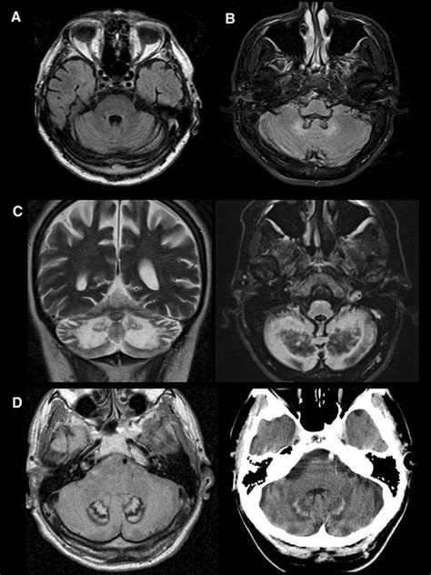 The Mri Spectrum Of Cerebellar Parenchymal Abnormalities In Ctx A