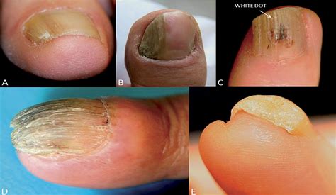 Proliferating Onychomatricoma Clinical Dermoscopical And The