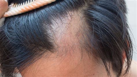 Alopecia Areata Causes Symptoms Management And Clinical Features