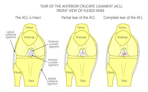 Acl Treatment And Surgeries In Portland