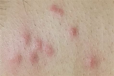 How To Identify A Bed Bug Bite Bed Bug Identification And Prevention