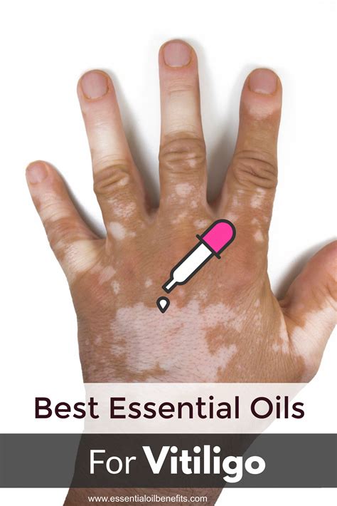 Best Essential Oils For Vitiligo In 2020 Vitiligo Vitiligo Treatment