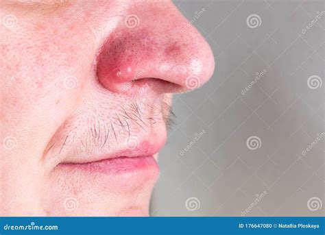 Black Dots And Acne On The Nose Stock Photo Image Of Girl Health