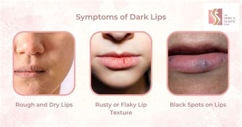 Dark Lips Treatment By Dermatologist The Skin And Shape Clinic