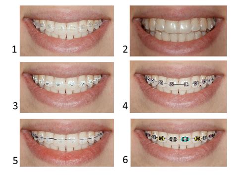Types Of Braces Pros And Cons Of Different Types Of Braces