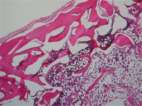Histopathology Of The Resected Specimen Lamellated Bony Trabeculae And