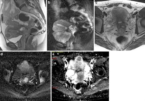 Staging Of Uterine Cervical Cancer With Mri Guidelines Of The European